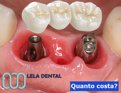 impianti-dentali-per-ponte-di-tre-denti-in-zirconio