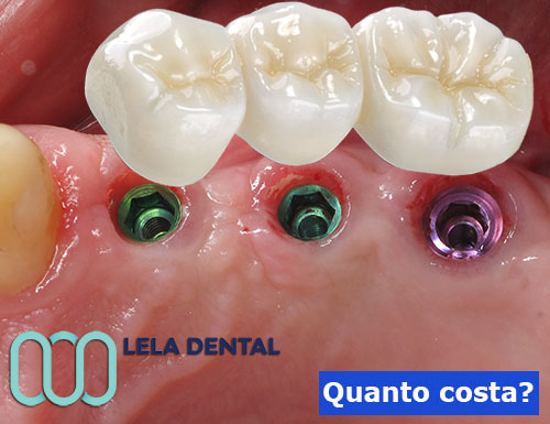 impianti-dentali-per-tre-denti-in-zirconio