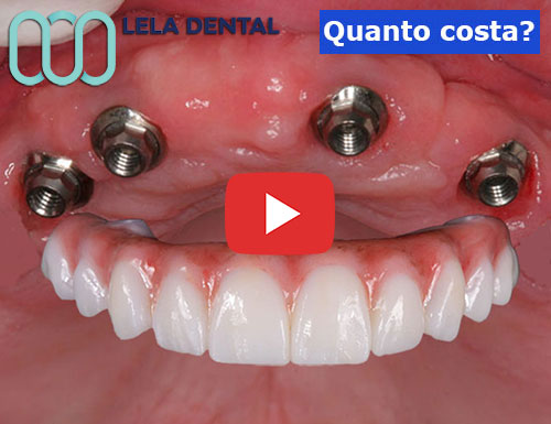 4-impianti-dentali-per-arcata-di-12-denti-in-zirconio
