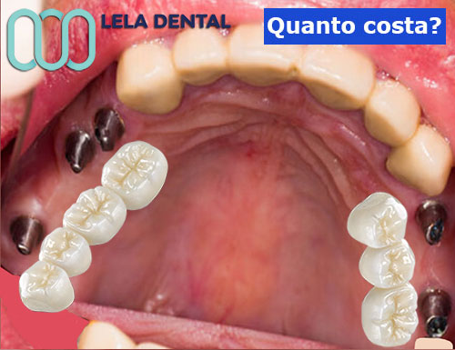 impianti-dentali-per-ripristino-arcata-per-due-ponti-in-zirconio