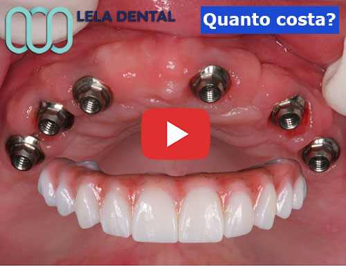 6-impianti-dentali-per-arcata-di-12-denti-in-zirconio
