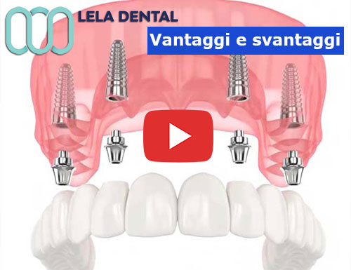 impianto-dentale-4-impianti-dentali-per-arcata-dentale-vantaggi-e-svantaggi