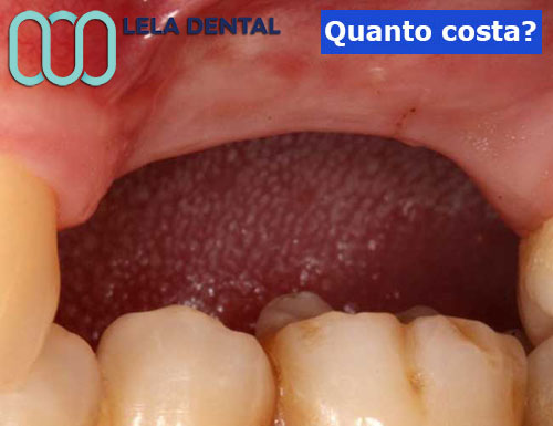 aumento-osso-mandibolare-maschellare