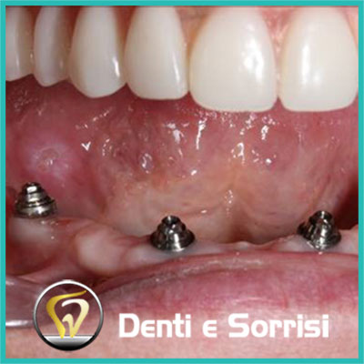 denti-e-sorrisi-turismo-dentale-in-albania-a-tirana-1