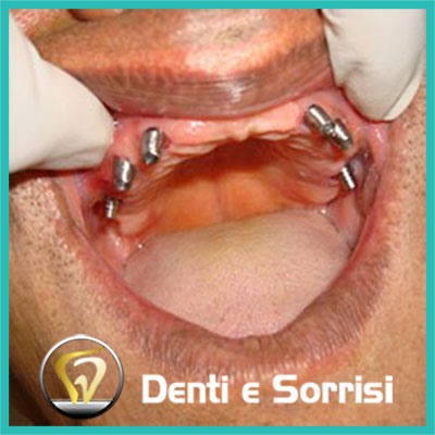 denti-e-sorrisi-turismo-dentale-in-albania-a-tirana-13