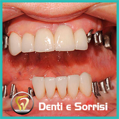 denti-e-sorrisi-turismo-dentale-in-albania-a-tirana-3