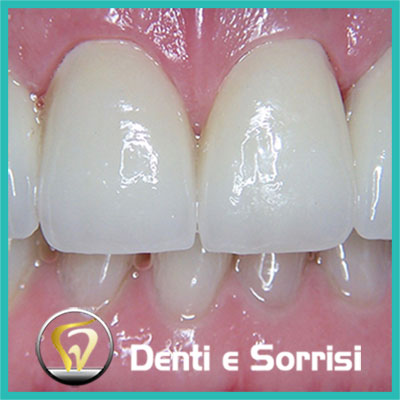 denti-e-sorrisi-turismo-dentale-in-albania-a-tirana-9