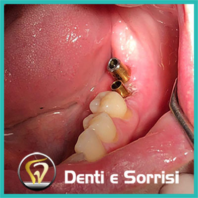 denti-e-sorrisi-turismo-dentale-in-albania-a-tirana-18