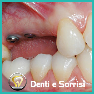 denti-e-sorrisi-turismo-dentale-in-albania-a-tirana-19