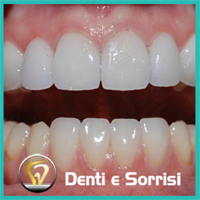 denti-e-sorrisi-turismo-dentale-in-albania-a-tirana-4