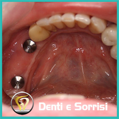 denti-e-sorrisi-turismo-dentale-in-albania-a-tirana-15