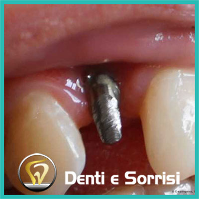 denti-e-sorrisi-turismo-dentale-in-albania-a-tirana-16