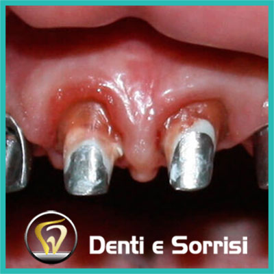 denti-e-sorrisi-turismo-dentale-in-albania-a-tirana-17