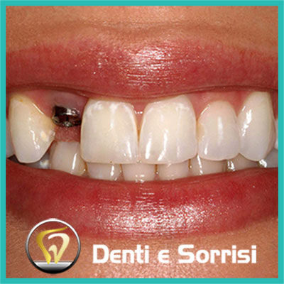denti-e-sorrisi-turismo-dentale-in-albania-a-tirana-1