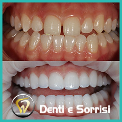 denti-e-sorrisi-turismo-dentale-in-albania-a-tirana-7