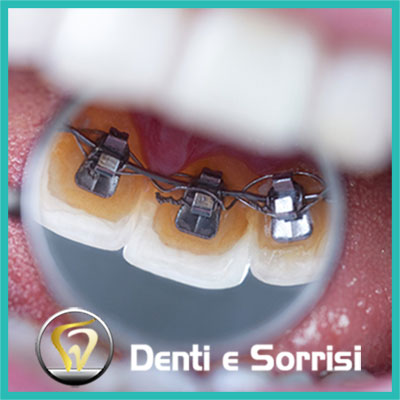 denti-e-sorrisi-turismo-dentale-in-albania-a-tirana-11