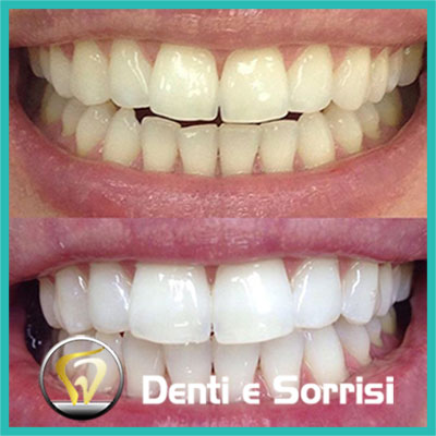 denti-e-sorrisi-turismo-dentale-in-albania-a-tirana-8