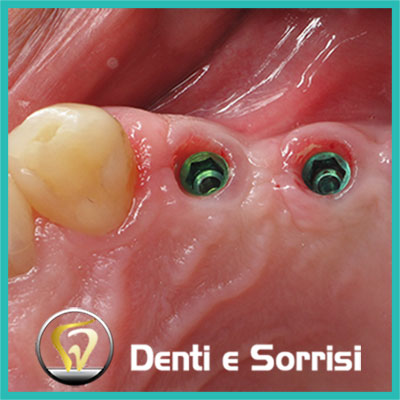 denti-e-sorrisi-turismo-dentale-in-albania-a-tirana-14
