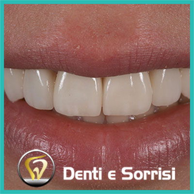 denti-e-sorrisi-turismo-dentale-in-albania-a-tirana-5