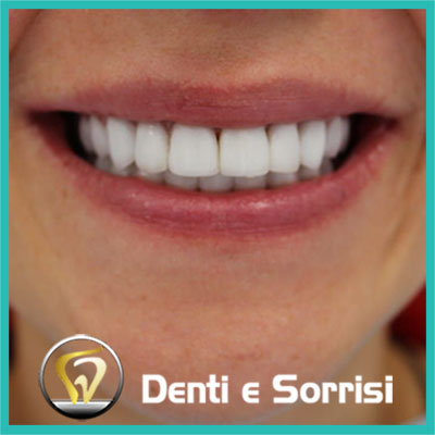 denti-e-sorrisi-turismo-dentale-in-albania-a-tirana-6