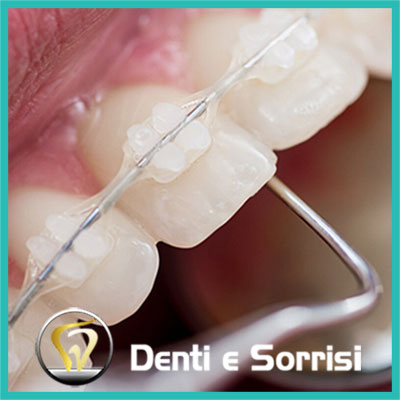 denti-e-sorrisi-turismo-dentale-in-albania-a-tirana-10