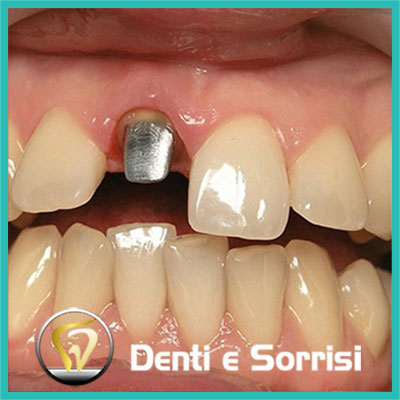 denti-e-sorrisi-turismo-dentale-in-albania-a-tirana-20