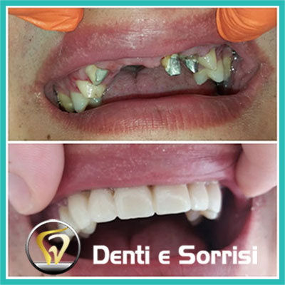 denti-e-sorrisi-turismo-dentale-in-albania-a-tirana-24