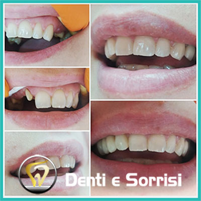 denti-e-sorrisi-turismo-dentale-in-albania-a-tirana-31
