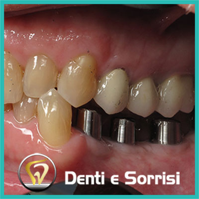 denti-e-sorrisi-turismo-dentale-in-albania-a-tirana-2