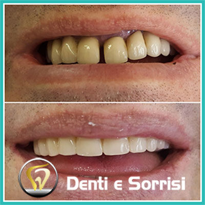 denti-e-sorrisi-turismo-dentale-in-albania-a-tirana-32