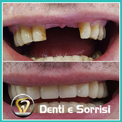 denti-e-sorrisi-turismo-dentale-in-albania-a-tirana-23