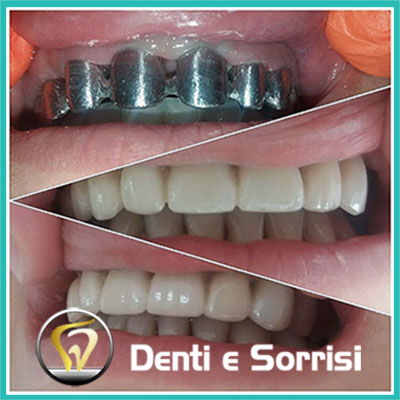 denti-e-sorrisi-turismo-dentale-in-albania-a-tirana-29