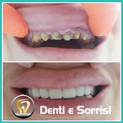 denti-e-sorrisi-turismo-dentale-in-albania-a-tirana-30