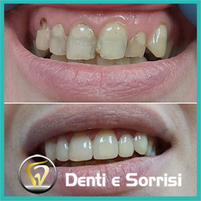 denti-e-sorrisi-turismo-dentale-in-albania-a-tirana-26