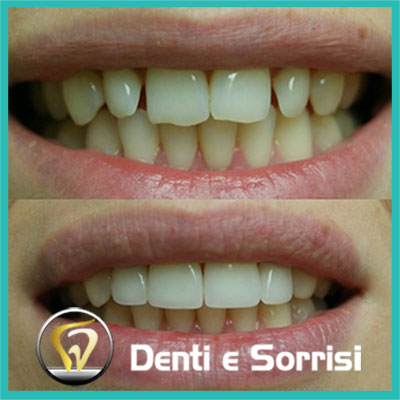 denti-e-sorrisi-turismo-dentale-in-albania-a-tirana-25