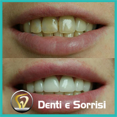 denti-e-sorrisi-turismo-dentale-in-albania-a-tirana-28