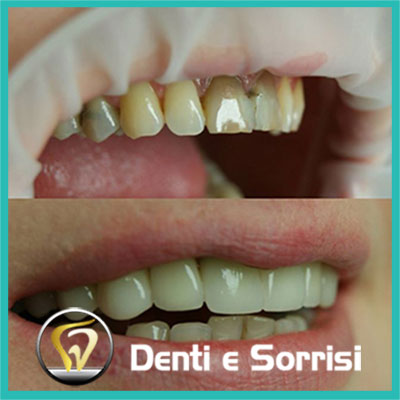 denti-e-sorrisi-turismo-dentale-in-albania-a-tirana-27