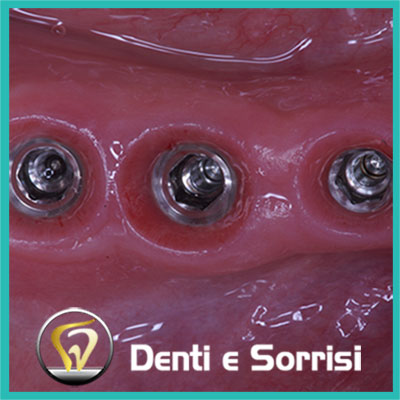 denti-e-sorrisi-turismo-dentale-in-albania-a-tirana-15