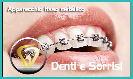 Prezzi-e-costi-Apparecchio-metallico-ortodontico