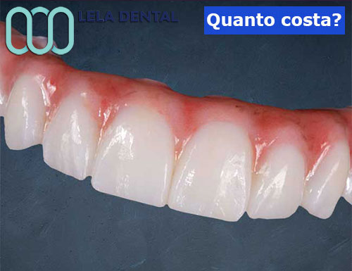 arcata-in-zirconio-con-gengive