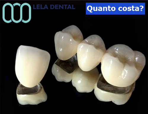 denti-in-metallo-ceramica