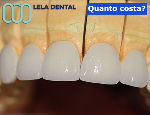 estetica-dentale-con-denti-in-metallo-ceramica