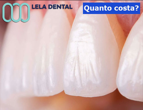 faccette-dentali