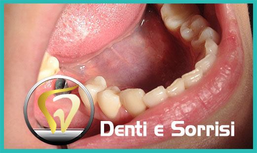 Denti in zirconio 15