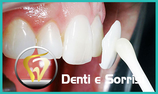 Denti in zirconio 17