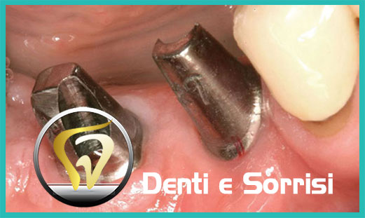 Implantologia dentale 20