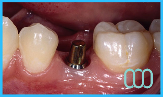 Prezzo costo ponte in zirconio 22